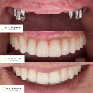 Before-After Pictures | DENTAGLOBAL. Dental Implants, Cosmetic ...