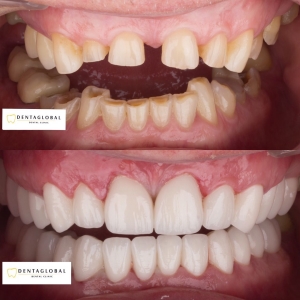 Before-After Pictures | DENTAGLOBAL. Dental Implants, Cosmetic ...