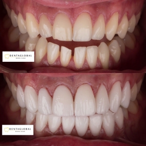 Before-After Pictures | DENTAGLOBAL. Dental Implants, Cosmetic ...