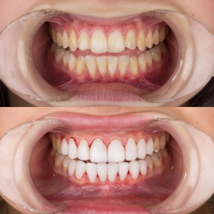 Before-After Pictures | DENTAGLOBAL. Dental Implants, Cosmetic ...